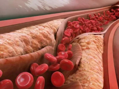 Чим вивести холестерин з організму? Ефективні методи очищення