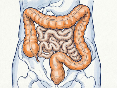 Чим лікувати коліт кишечника? Ефективна стратегія відновлення