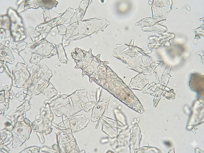 Підшкірний кліщ? Як позбутися демодексу натуральними методами