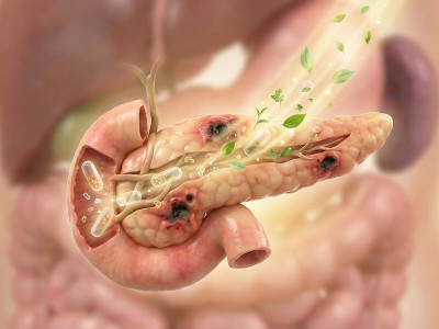 Чим лікувати підшлункову? Ефективне відновлення та підтримка