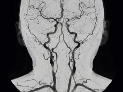 Чим лікувати звуження судин головного мозку в домашніх умовах?