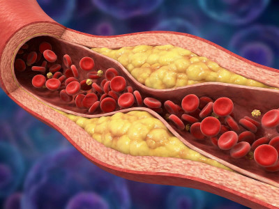 Чим замінити статини? Ефективна та безпечна альтернатива