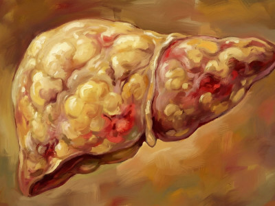 Чим лікувати жировий гепатоз? Натуральна стратегія відновлення печінки